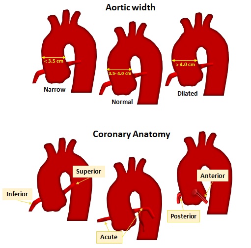 Aortic width and Coronary Anatomy